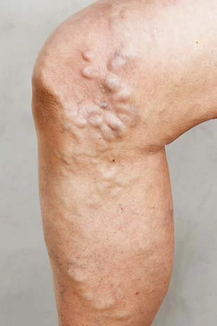 Illustration of Varicose Veins